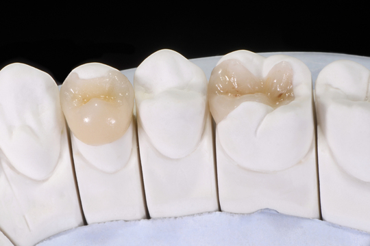 名古屋市熱田区で銀歯を白くする、白い歯の治療なら、くまざわ歯科