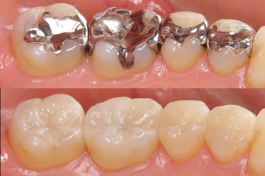 歯医者で金属アレルギー対策・メタルフリー歯科なら、くまざわ歯科 ...